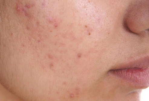 Beating Acne