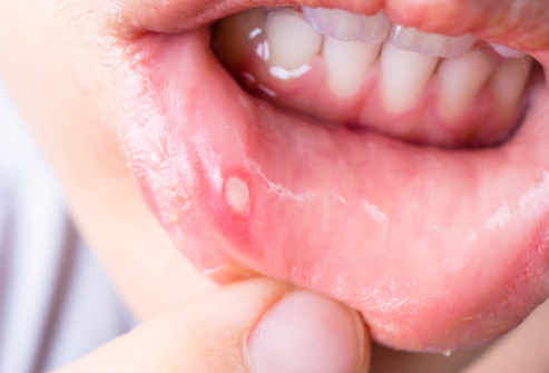 Mouth Ulcers