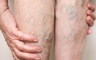 Varicose Veins