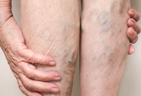 Varicose Veins