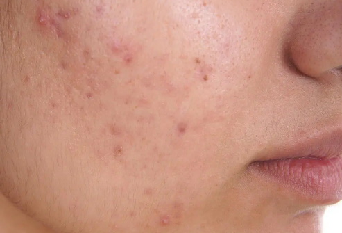 Acne